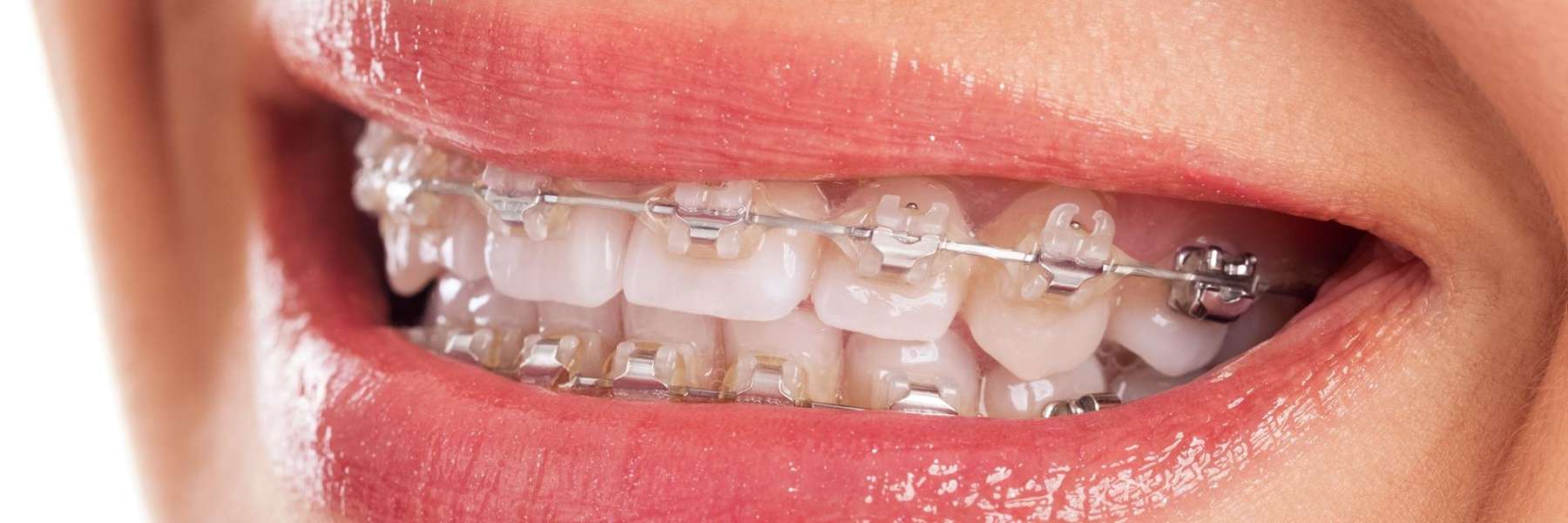 Patient's teeth with braces from Jerger Pediatric Dentistry